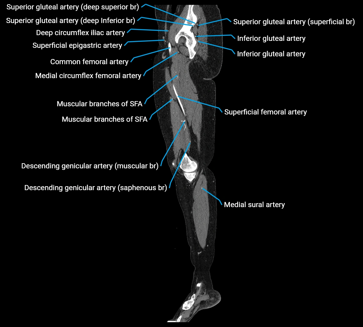 CTA lower limb sagittal cross sectional anatomy labelled image _29 (3).webp